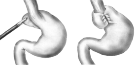Foodpipe Tightening or Acidity Surgery