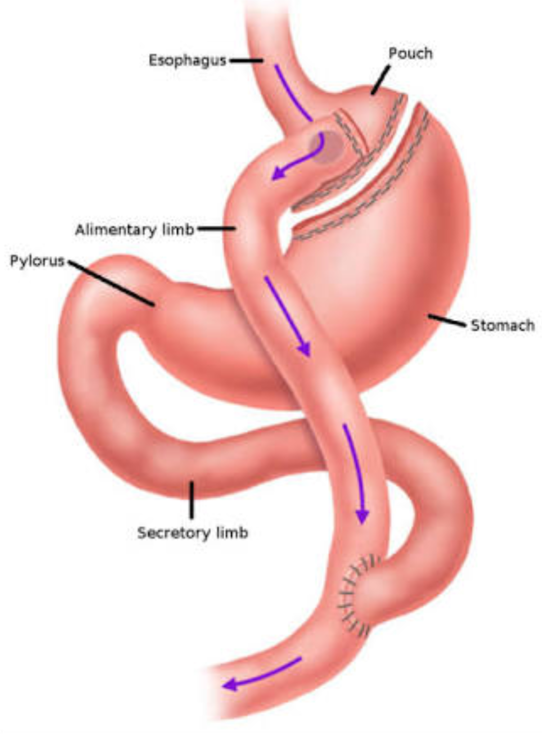 Mini Gastric Bypass Surgery In Pune Bariatric Surgery In Pune