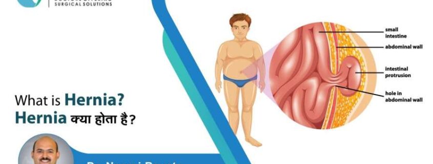 What is Hernia? and Type of Hernia