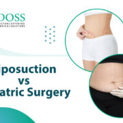 Liposuction VS Bariatric Surgery