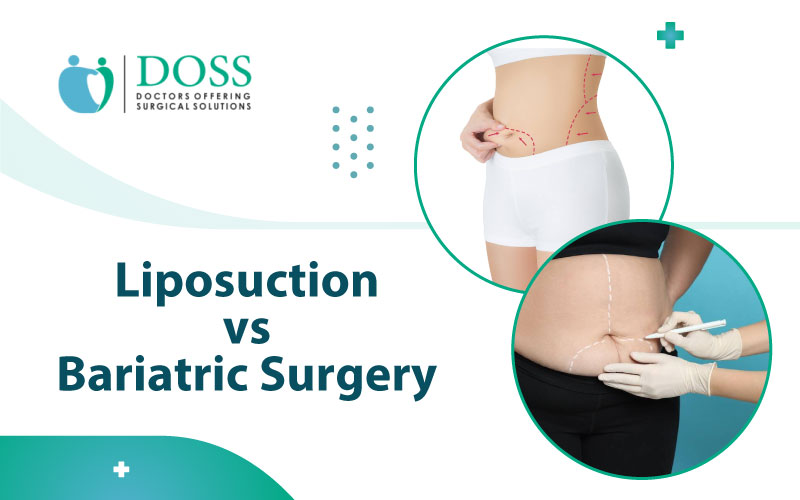 Liposuction VS Bariatric Surgery