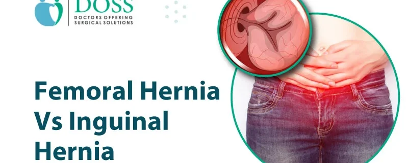 Femoral-Hernia-vs-Inguinal-Hernia