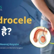 What is hydrocele ?