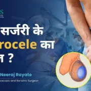 hydrocele without surgery