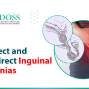 Direct-and-Indirect-Inguinal-Hernias